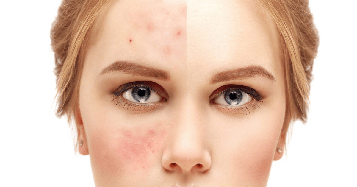 rukhma anti acne serum ()